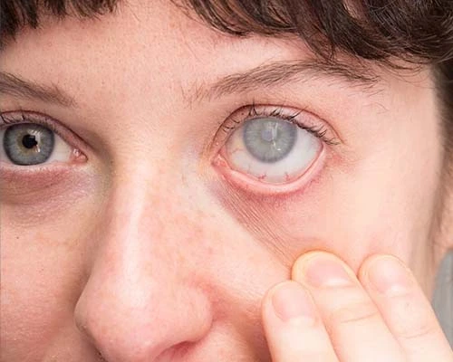 Ojo con cataratas — Dr. Abner Rivera Mexicali
