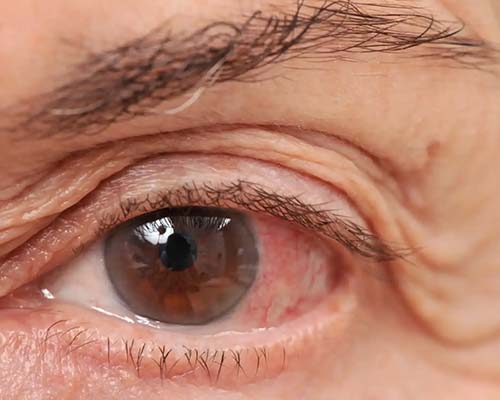 Tratamiento de Glaucoma