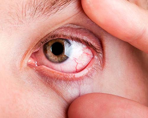 Tratamiento de Ojo Seco