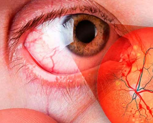 Retinopatía Diabética