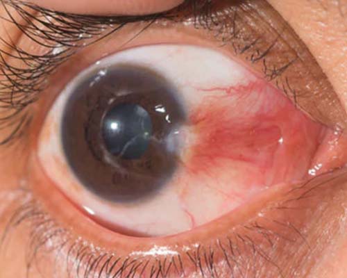 Cirugía de Pterigión